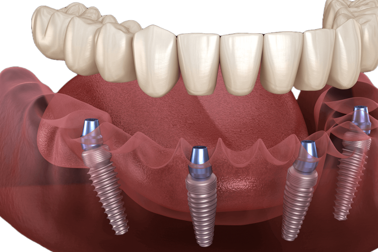 Permanent Teeth in One Day
