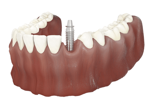 Complex Procedures