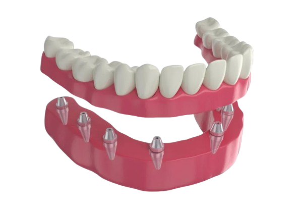 Full-Mouth Rehabilitation