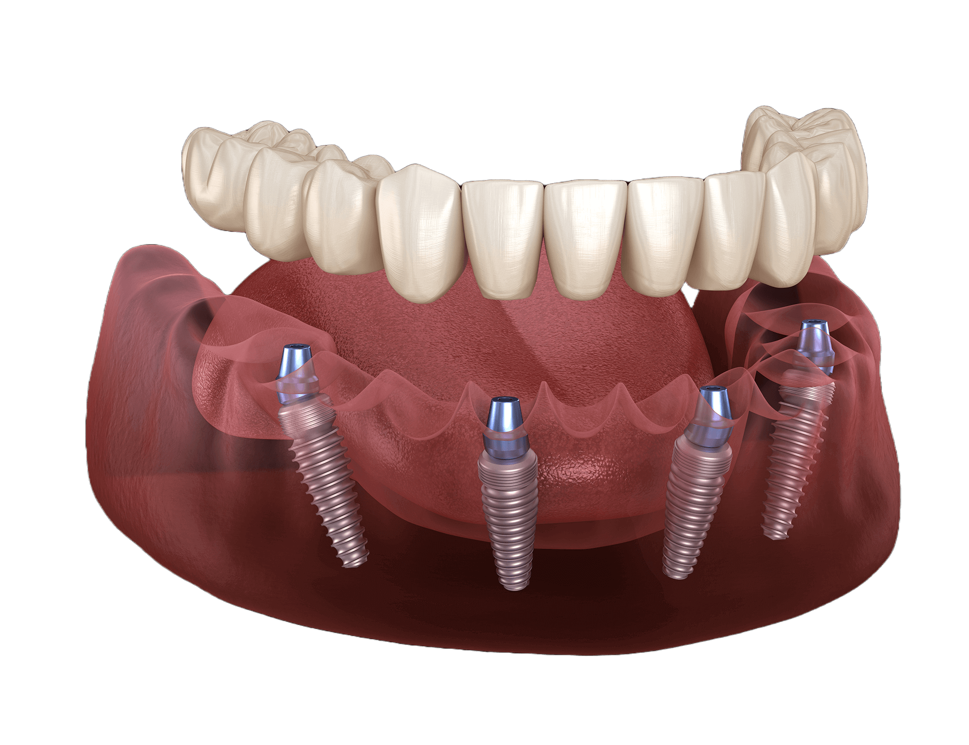 Premium Zirconia Restoration - Single Arc