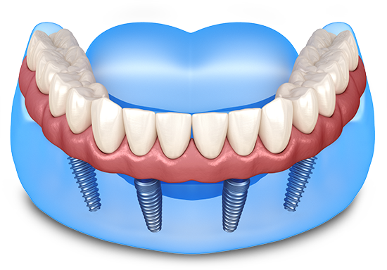 All-on-4 Full-Mouth Implants