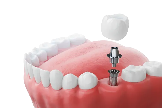 All-on-4 Full-Mouth Implants